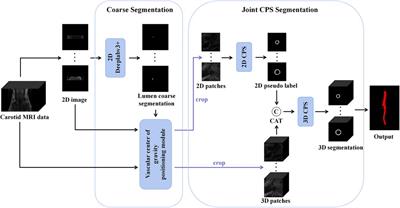 Joint 2D–3D cross-pseudo supervision for carotid vessel wall segmentation